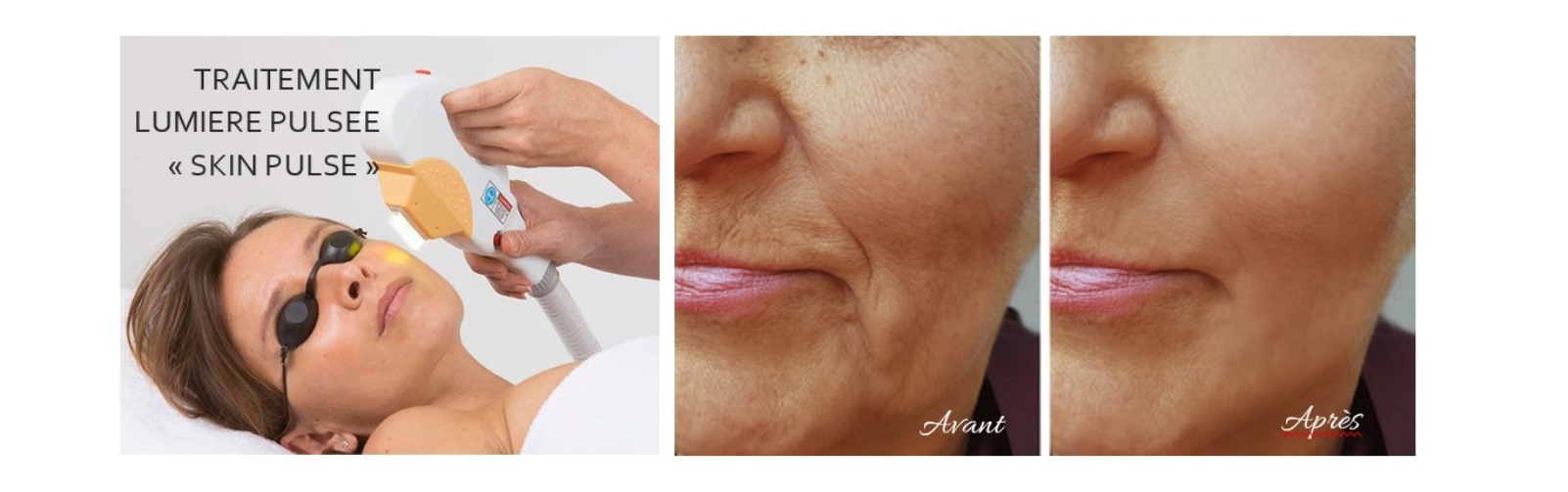 Lumière pulsée Visage